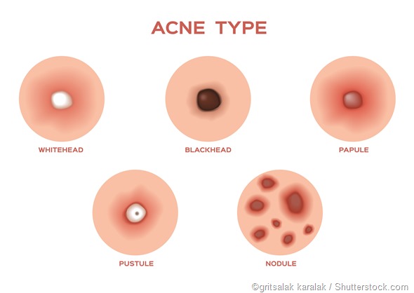 Acne: when to seek help?