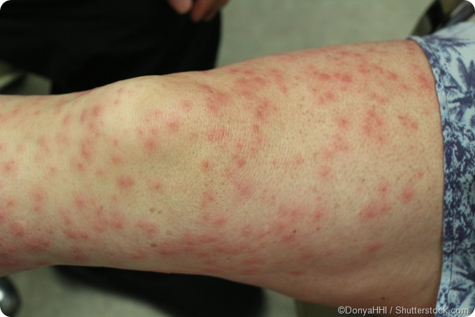 allergic contact dermatitis