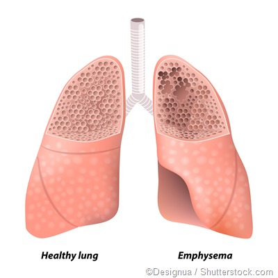 emphysema lung illustration - Designua