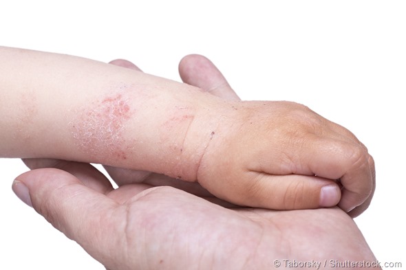 Eczema