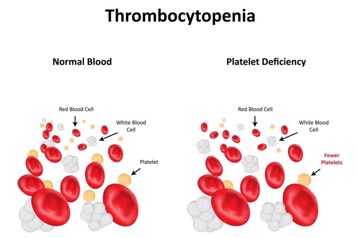 thrombocytopenia és magas vérnyomás