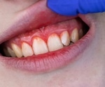 How Oral Health Affects Alzheimer's: Inflammation, Pathogens, and Prevention