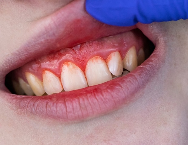 How Oral Health Affects Alzheimer's: Inflammation, Pathogens, and Prevention