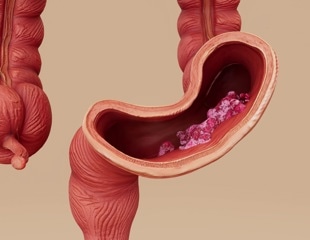 The Role of the Gut Microbiome in Gastrointestinal Cancer Development