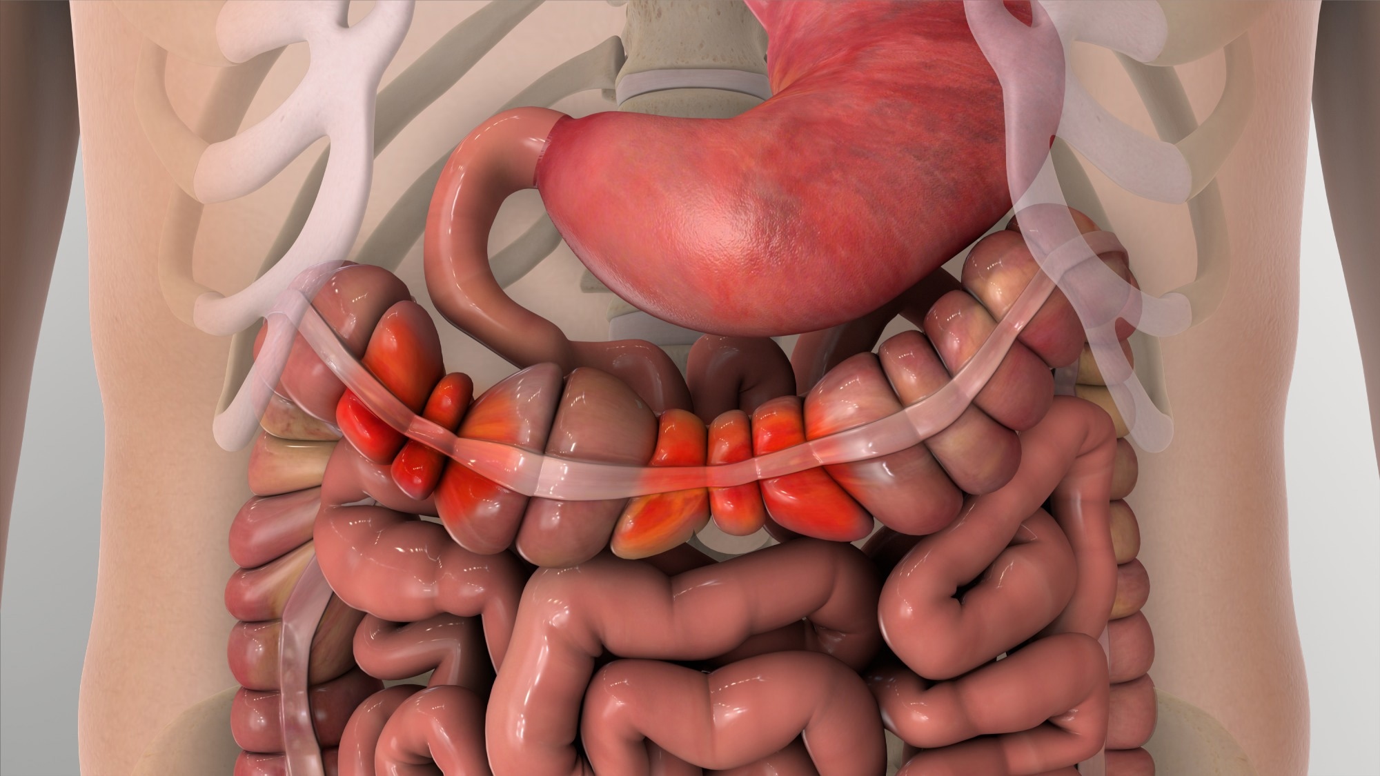 IBS Irritable bowel syndrome 3D rendering