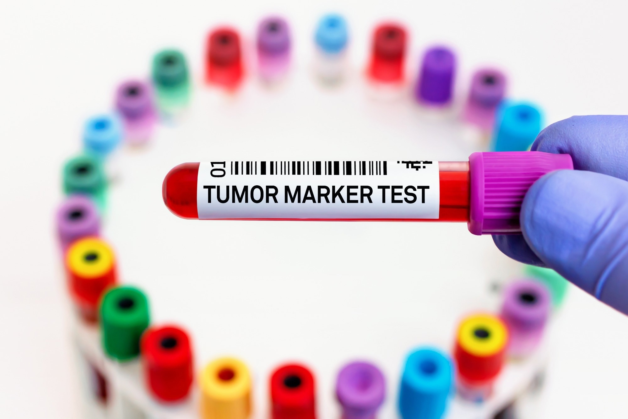 Blood tube for Study of Tumor Marker test in biochemistry lab. doctor with blood tube labeled with Tumor marker for analysis of cancer biomarkers test