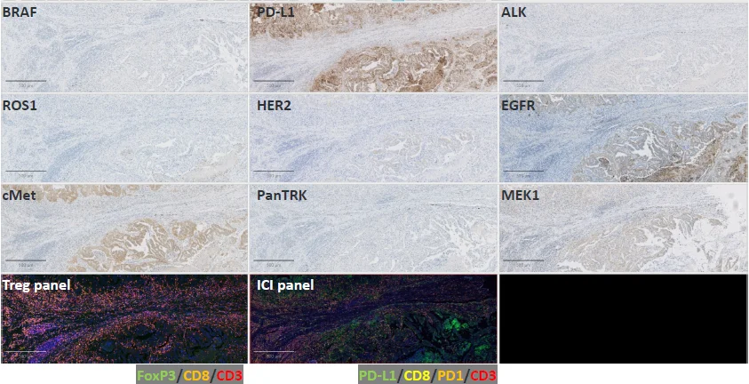 Example of IHC staining observed for one screened NSCLC sample of unknown target status