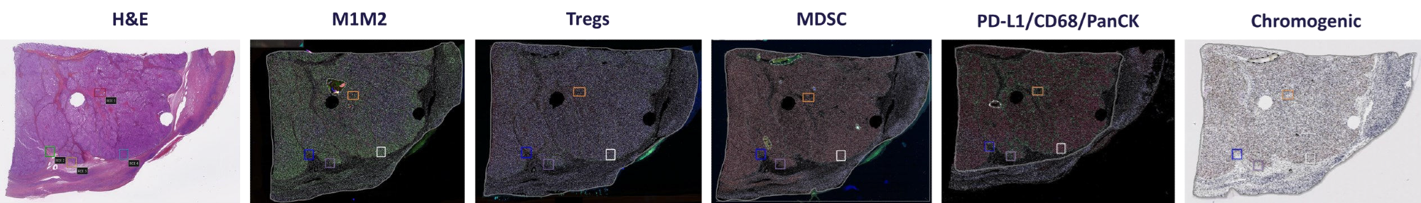 ROI Mapping on an ovary cancer sample