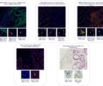 Why multiplex IHC is becoming essential for precision immunotherapy development