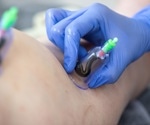 Leech Therapy: How It Works and Its Uses in Modern Medicine
