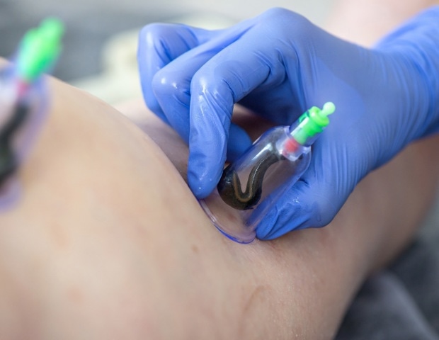 Leech Therapy: How It Works and Its Uses in Modern Medicine