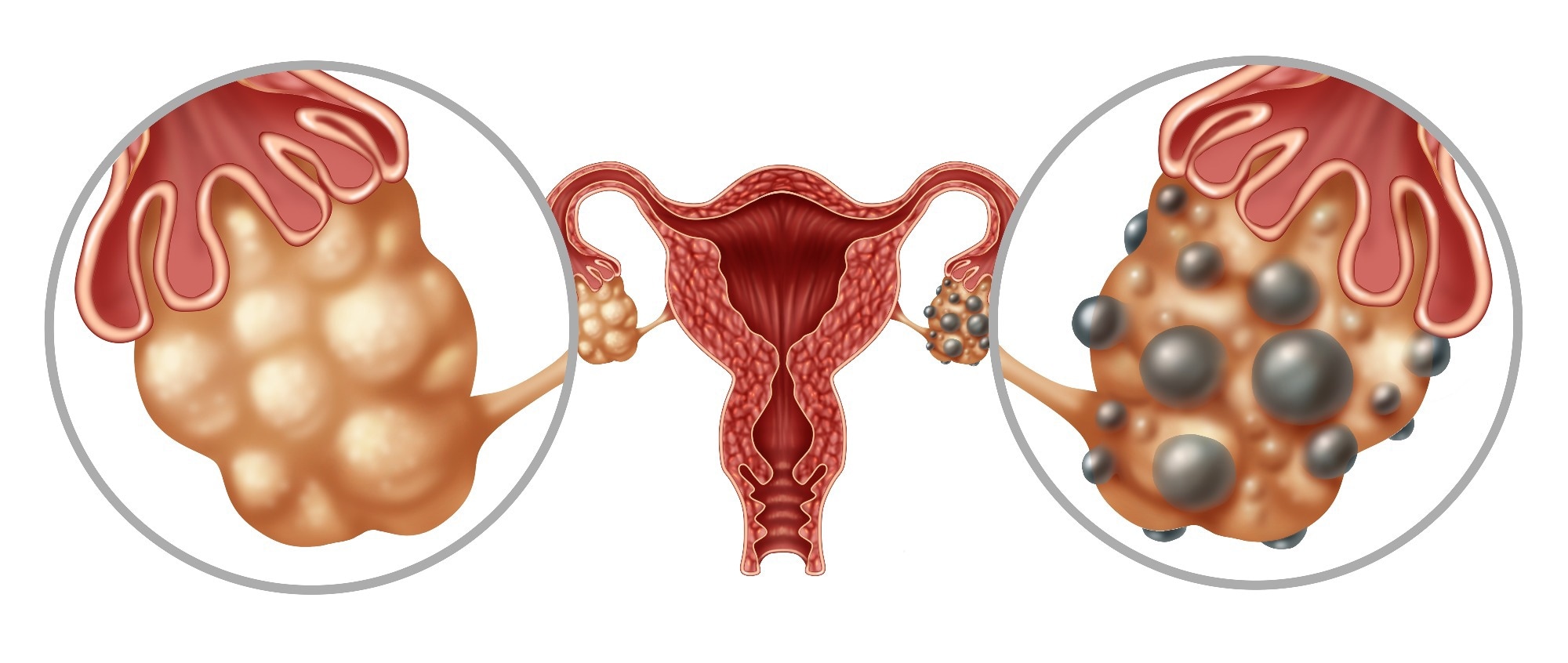 Normal vs. cystic ovary