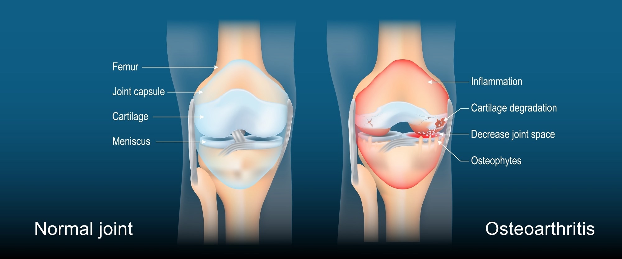 Normal joint vs. osteoarthritis
