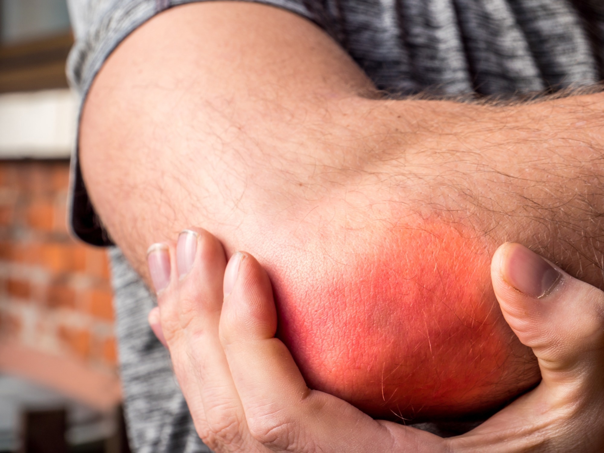 Inflamed elbow of man