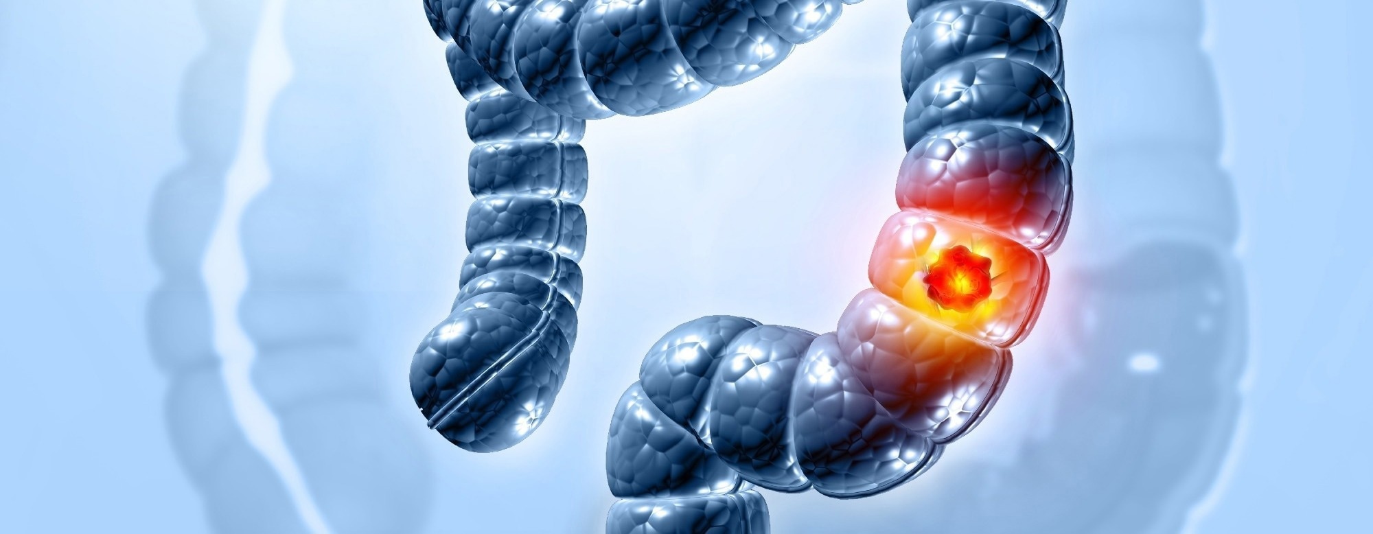 Lifetime heavy drinking sharply raises colorectal cancer risk, major US study finds