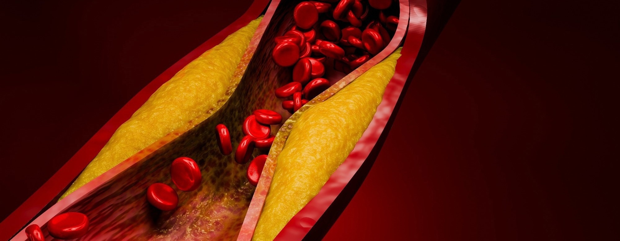 Evolocumab trial could reshape how doctors treat high-risk cholesterol patients