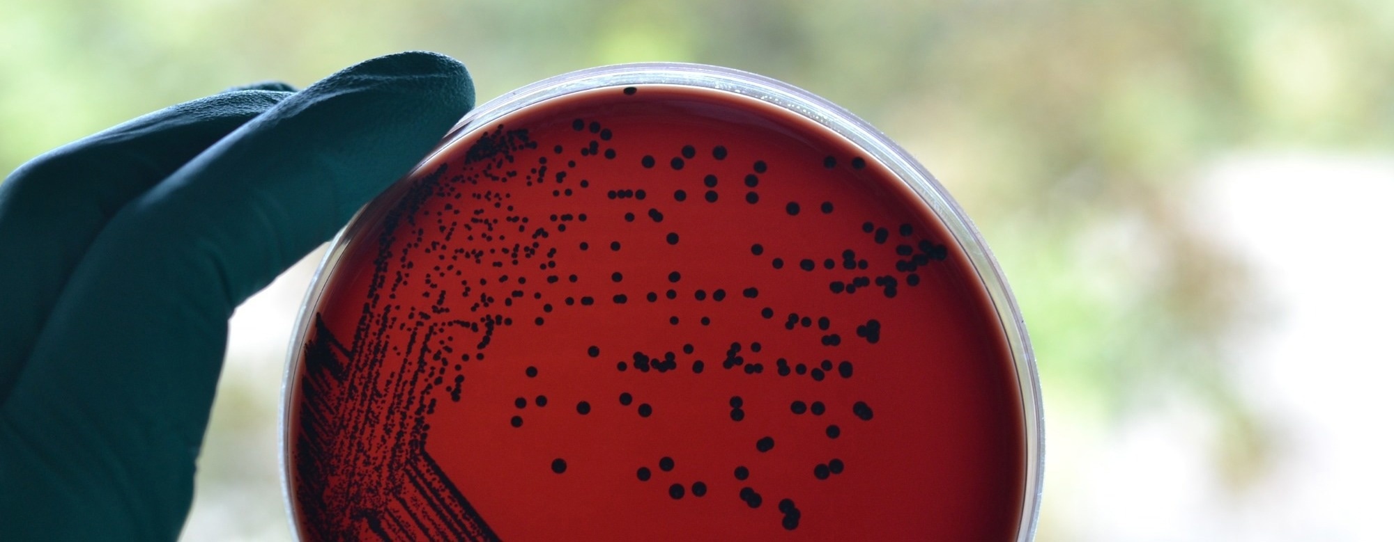 Australia’s diphtheria outbreak shows why boosters, antibiotics, and better housing all matter