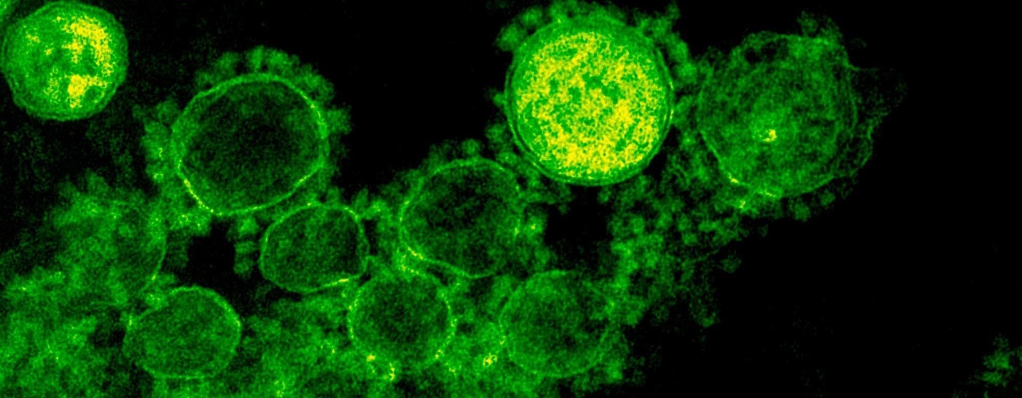 Severe COVID-19 reactivates dormant viruses and may leave a lasting viral signature