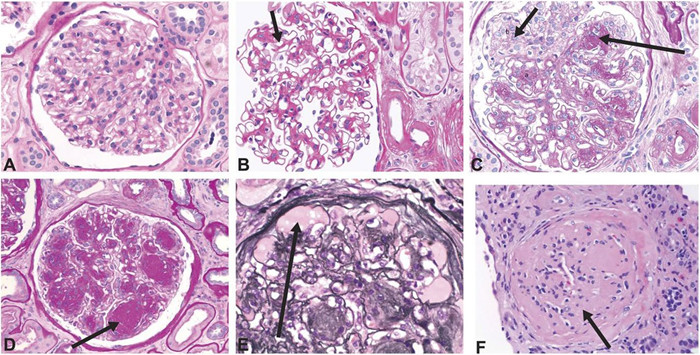 Histology images showing structural changes related to diabetic glomerulopathy. <strong>A</strong> Normal glomerulus. <strong>B</strong> Diffuse mesangial expansion with mesangial cell proliferation. <strong>C</strong> Prominent mesangial expansion with early nodularity and mesangiolysis. <strong>D</strong> Accumulation of mesangial matrix forming Kimmelstiel-Wilson nodules. <strong>E</strong> Dilation of capillaries forming microaneurysms, with subintimal hyaline (plasmatic insudation). <strong>F</strong> Obsolescent glomerulus. <strong>A</strong>–<strong>D</strong> and <strong>F</strong> were stained with period acid-Schiff stain. <strong>E</strong> was stained with Jones stain. Original magnification ×400. Reprinted with permission from American Society of Nephrology