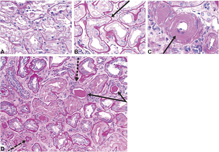 Histology images showing tubulointerstitial changes seen in diabetic kidney disease. <strong>A</strong> Normal kidney cortex. B Thickened tubular basement membrane and interstitial widening. <strong>C</strong> Arteriole with an intimal accumulation of hyaline material with significant luminal compromise. D Renal tubules and interstitium in advancing diabetic kidney disease, with thickening and wrinkled tubular basement membranes (solid arrows), atrophic tubules (dashed arrow), some containing casts, and interstitial widening with fibrosis and inflammatory cells (dotted arrow). All sections stained with period acid-Schiff stain, original magnification ×200. Reprinted with permission from American Society of Nephrology
