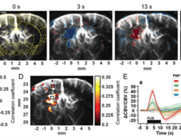Functional ultrasound (fUS) vs. focused ultrasound (FUS) for brain activity mapping