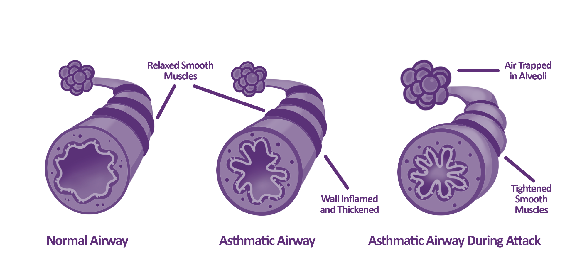Understanding hidden inflammation in asthma