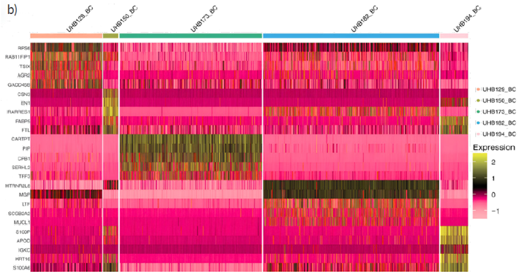 Single-cell profiling of patient-derived breast cancer tissue after slow-freezing in Bambanker™. a) Single-cell clustering identified multiple cell populations, including breast cancer cells, fibroblasts, immune cell subsets, epithelial cells, endothelial cells, melanocytes, and other stromal or immune populations. b) Marker-expression analysis showed breast cancer-relevant gene-expression patterns across recovered breast cancer cell populations. Together, these panels illustrate that Bambanker™-preserved patient-derived tissue could support downstream single-cell cellular profiling after thawing