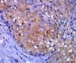 A practical guide to multiplex IHC troubleshooting