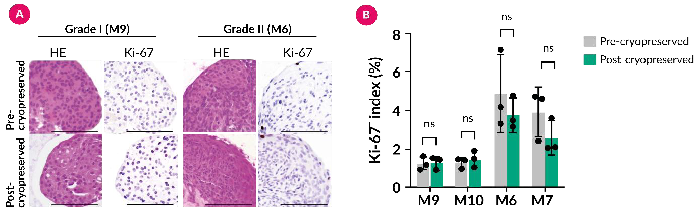 Post-thaw meningioma organoids retain histological features and proliferative activity. (A) Representative H&E sections show that the post-thaw organoids preserve a densely cellular, organized tissue architecture comparable with the pre-cryopreservation culture. Ki-67 staining identifies proliferating nuclei before freezing and in both post-thaw examples after one week of recovery. Scale bars: 100 μm. (B) The Ki-67-positive index measured across three fields shows no significant difference between conditions (mean ± SD; P = 0.543), indicating that proliferative capacity was maintained within the limits of the analysis