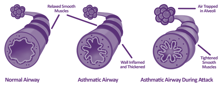 What does it really mean to control asthma?