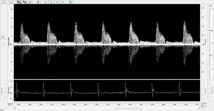 Carotid