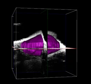 Mammary Fat Pad Tumor in Mouse – 3D Volume = 263 mm3