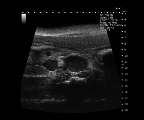 Mouse Supra-Renal Abdominal Aorta Aneurysm in B-Mode.