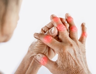Eating fish and seafood reduces risk of rheumatoid arthritis