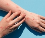 How should we react to the global monkeypox outbreak?