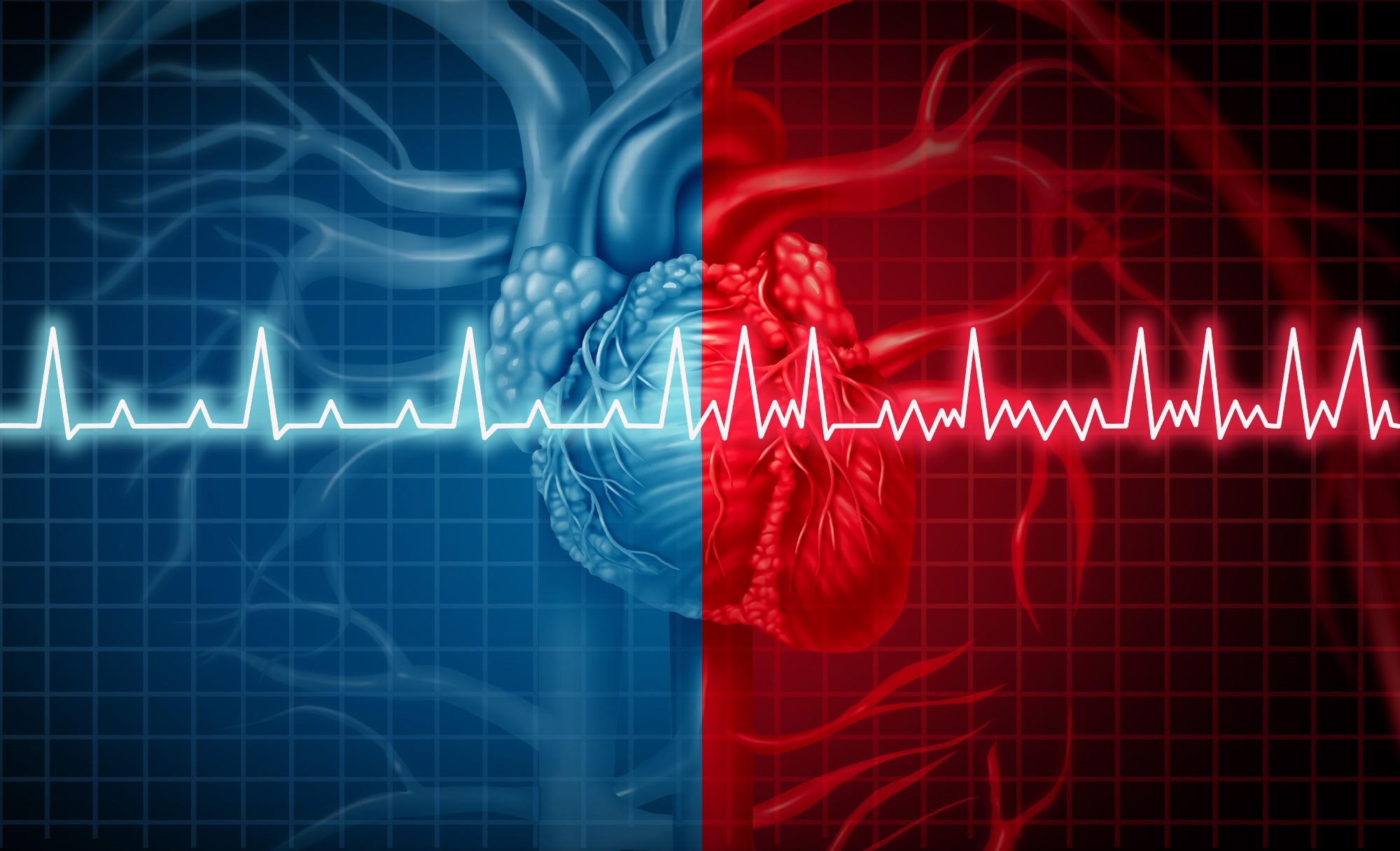 Sudden cardiac death risk can be determined by genetic score