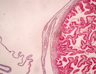 Placental inflammation's role in adult depression and heart disease