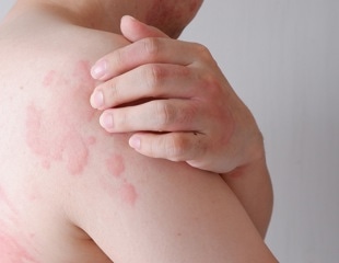 New study classifies CSU skin eruptions into five categories using mathematical modeling