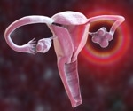 New review aims to help clinicians diagnose and manage PCOS