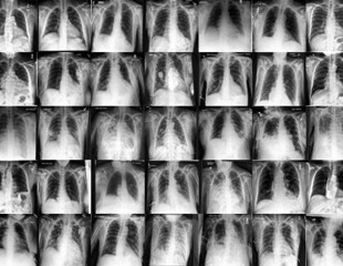Can synthetic data boost fairness in medical imaging AI?