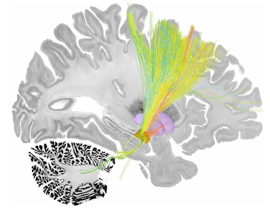 New algorithm enhances deep brain stimulation for Parkinson