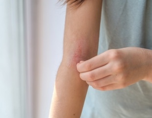 Study suggests limiting oral corticosteroid use to 90 days reduces adverse effects in atopic dermatitis patients