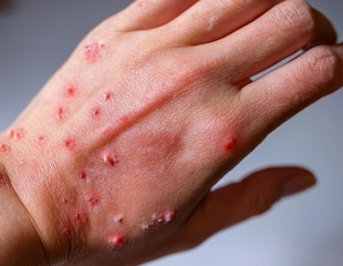 A review of clinical features, diagnosis, and management of Mpox