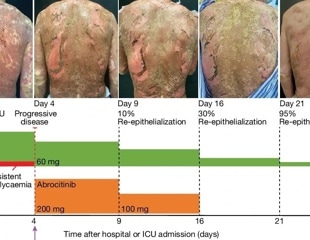 Researchers uncover the potential of JAK inhibitors to treat life-threatening skin disease