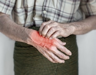 Heated mittens show promise in easing osteoarthritis pain and stiffness