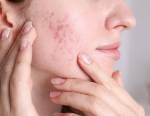 What drives acne relapse? New study explores isotretinoin outcomes