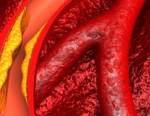 Obicetrapib slashes LDL cholesterol by over 30% in high-risk heart patients