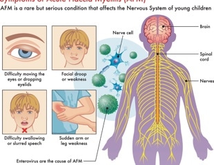 Gaps in surveillance leave European children at risk of acute flaccid myelitis