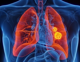 IL-6 and CRP offer limited boost for predicting infections after lung cancer surgery