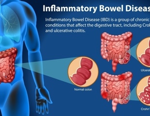 Western diet fuels IBD by derailing the microbiome - can precision nutrition turn the tide?